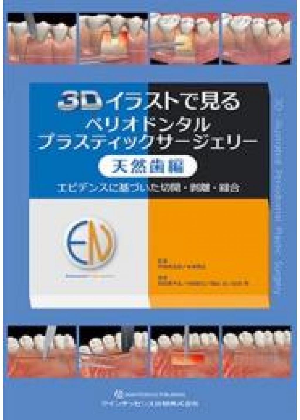 3Dイラストで見るペリオドンタルプラスティックサージェリー 天然歯編 
