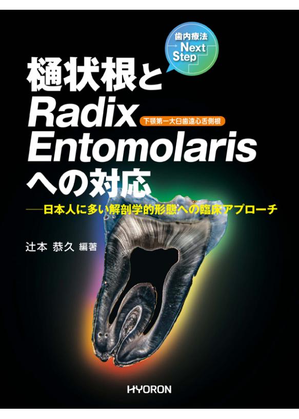 歯内療法Next Step　樋状根とRadix Entomolarisへの対応 の画像です