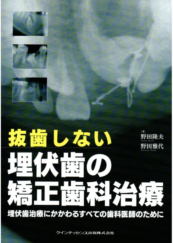 抜歯しない埋伏歯の矯正歯科治療の画像です